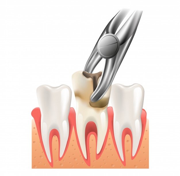 Painless Tooth Extraction Treatment Noida